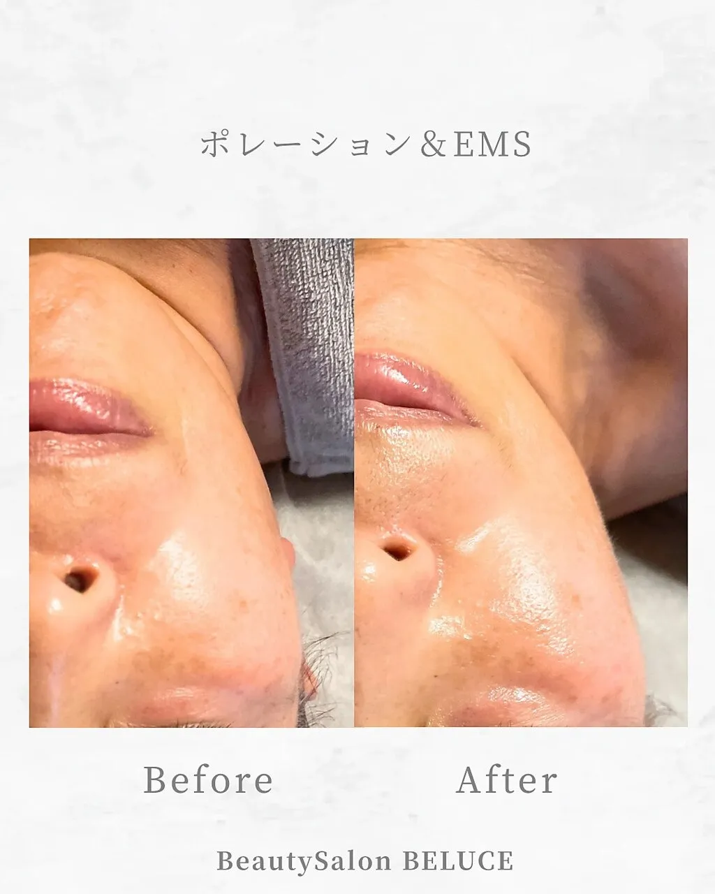 たるみ、シワ改善